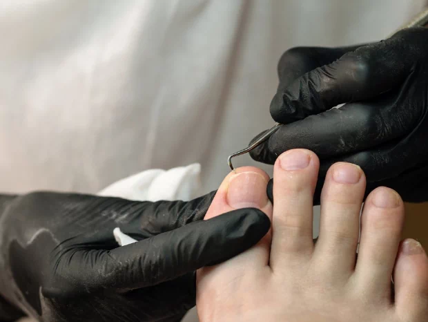 Leczenie paznokci pourazowych oraz zmienionych chorobowo