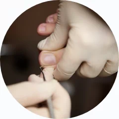 Leczenie wrastających i wkręcających się paznokci